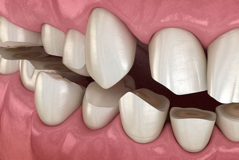 Misshapen teeth