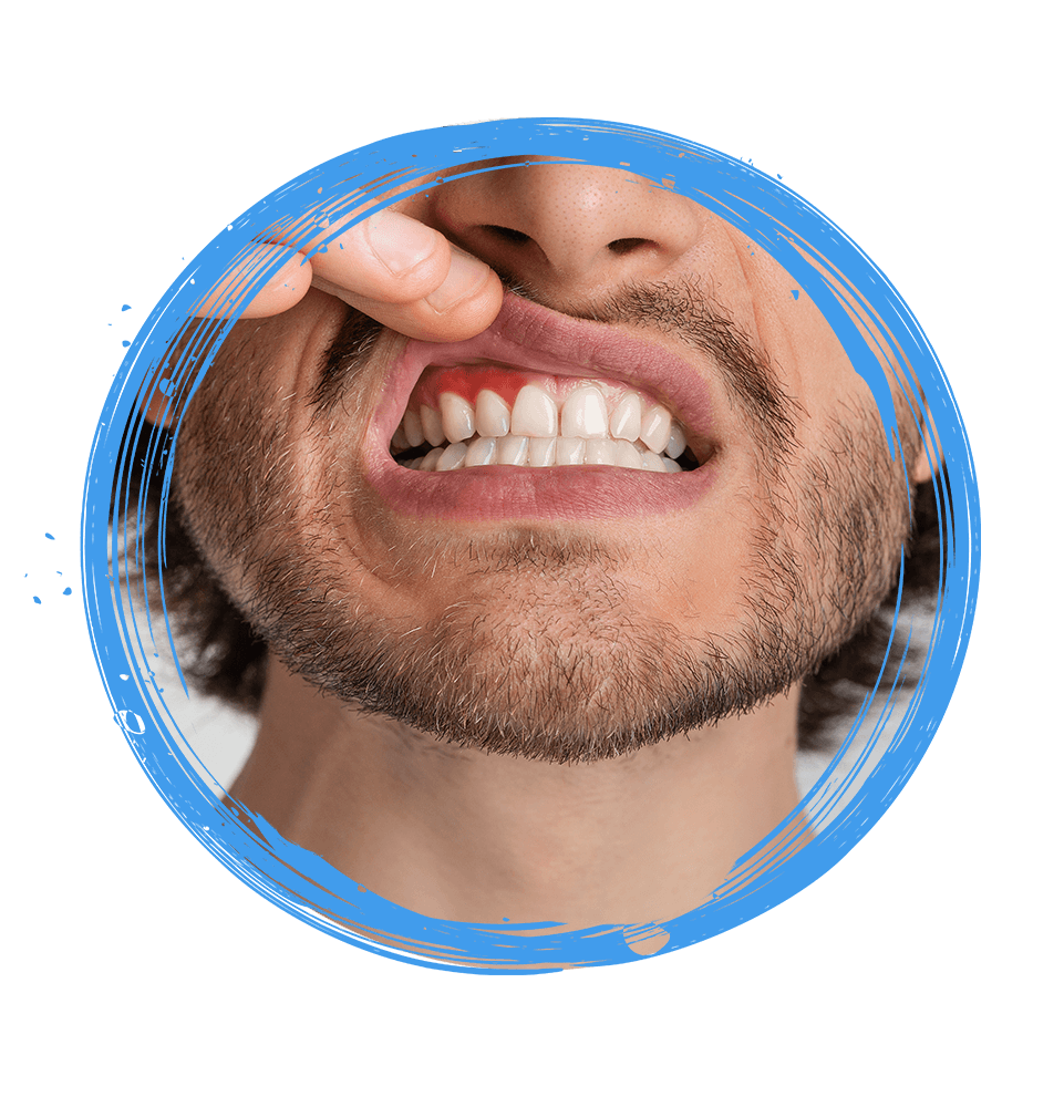 Gum disease