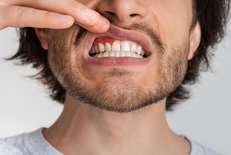 Gum disease