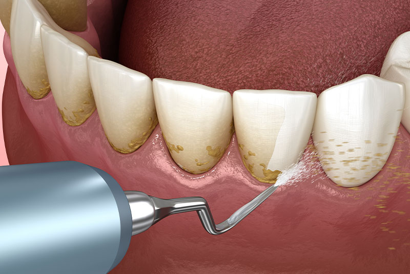 Tooth cleaning process