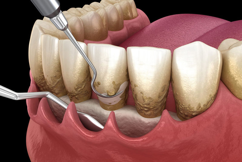 Osseous Surgery