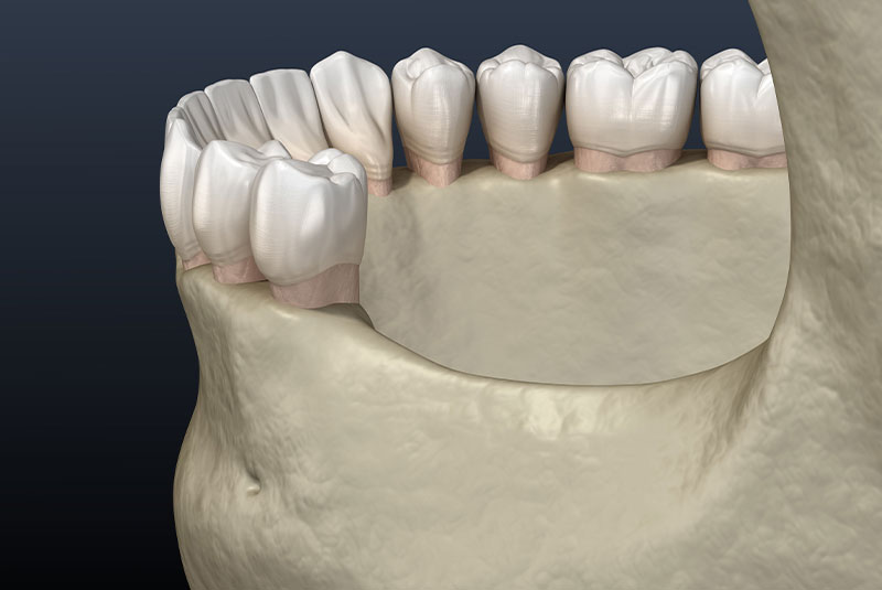 bone loss