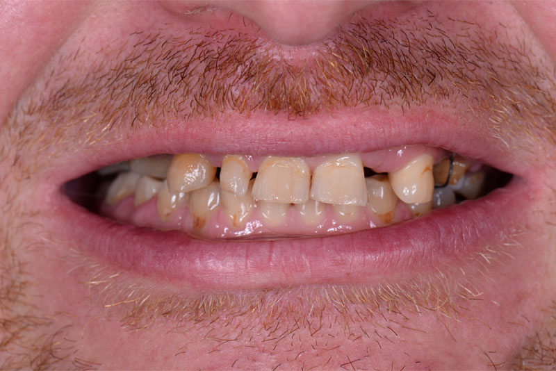 Before: before dental procedure