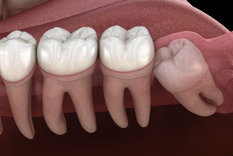 Impacted teeth