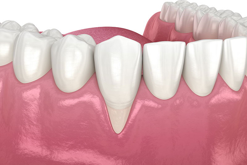 Gum recession