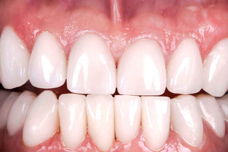 After: after dental procedure
