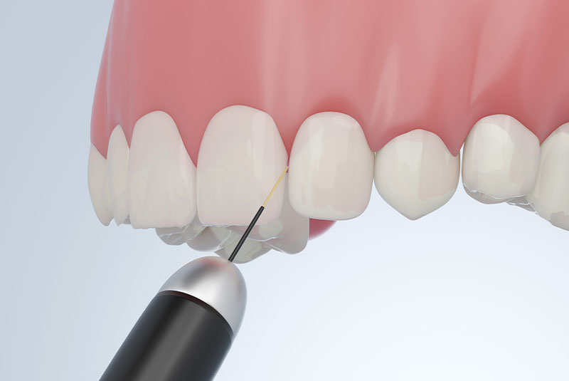 Dental laser