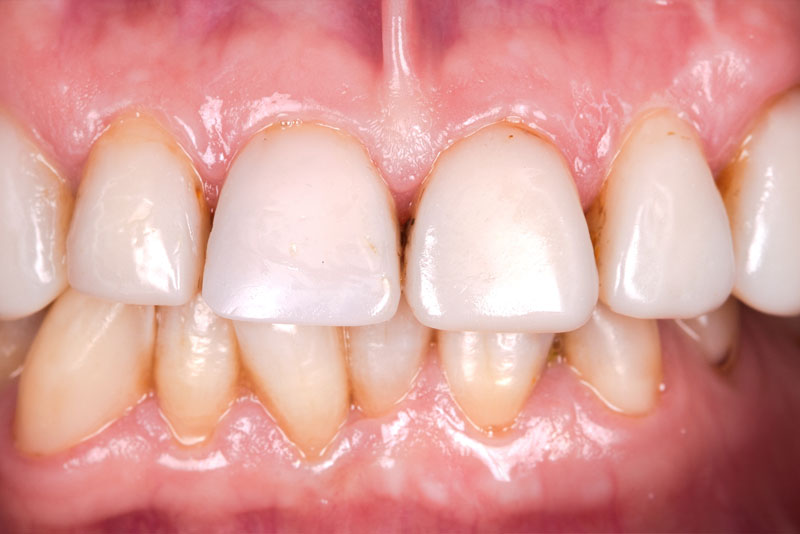 Before: before dental procedure