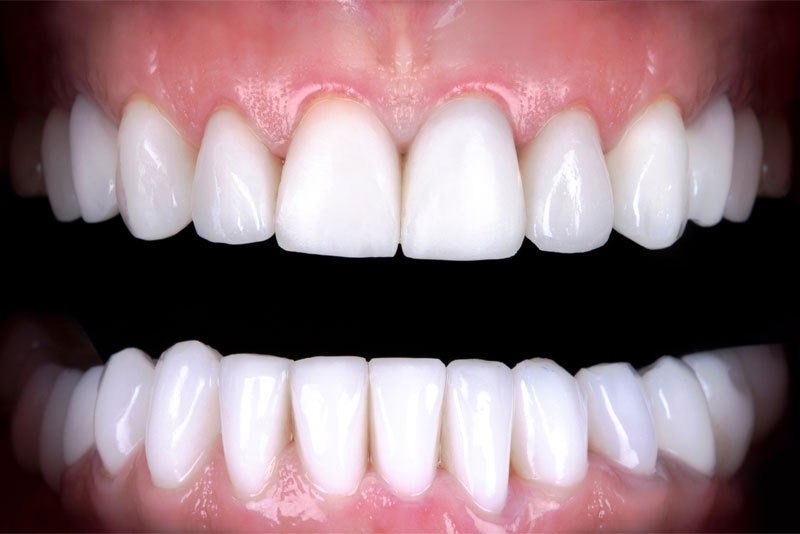 After: after dental procedure
