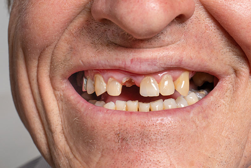 missing tooth