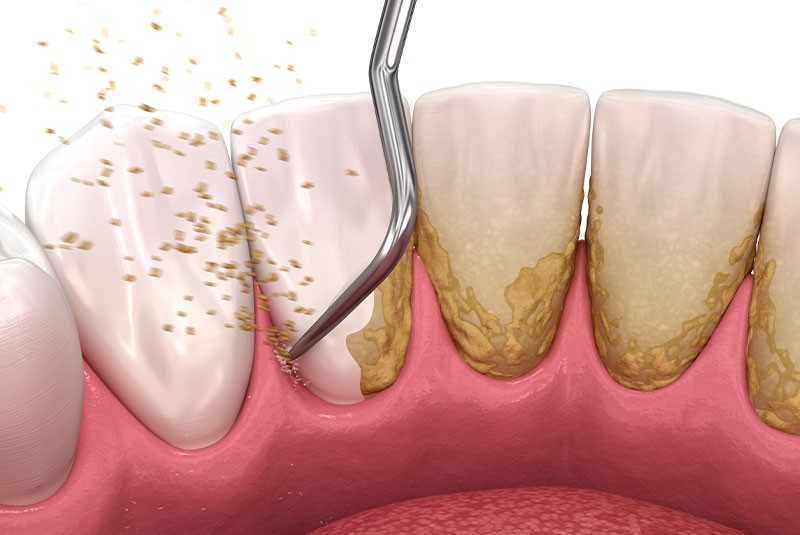 Tooth cleaning