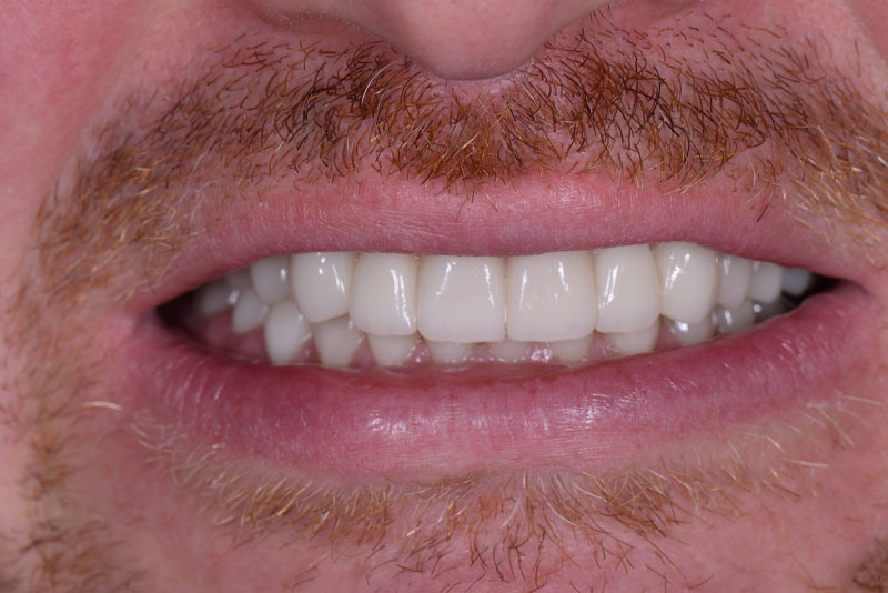 After: after dental procedure