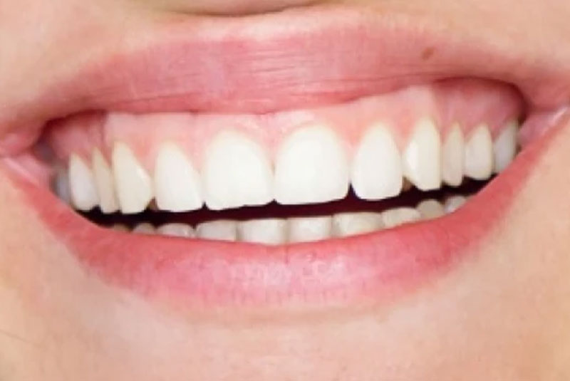 Gummy smile