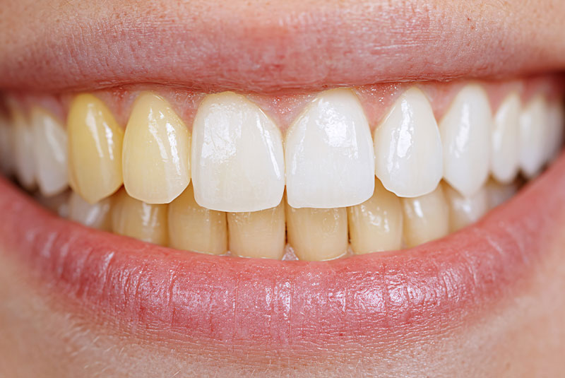 Discolored teeth