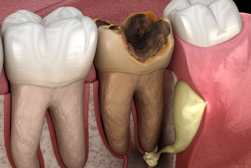 Infected tooth