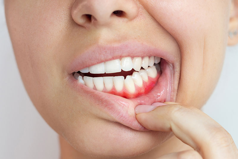 Gum disease
