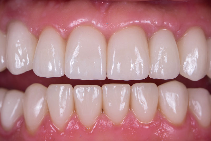 After: after dental procedure