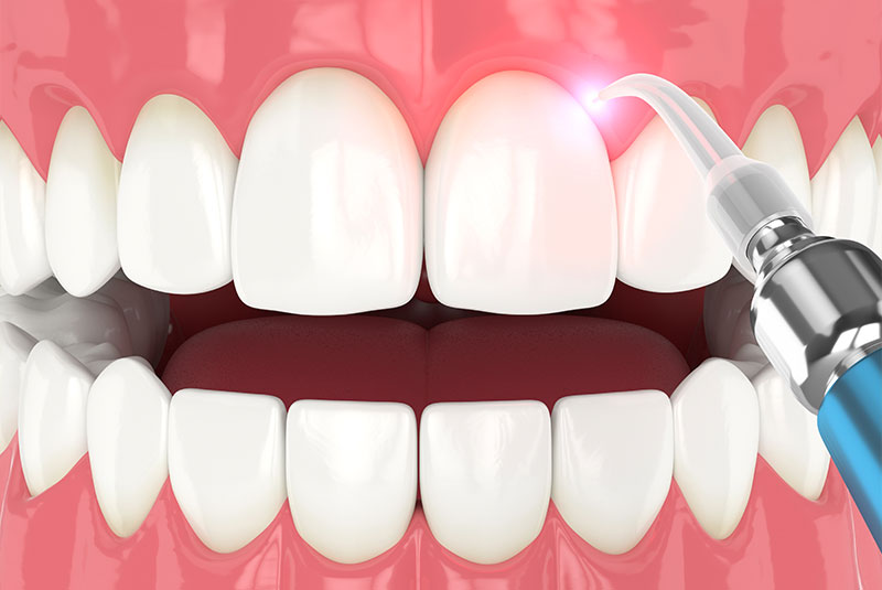 Dental laser